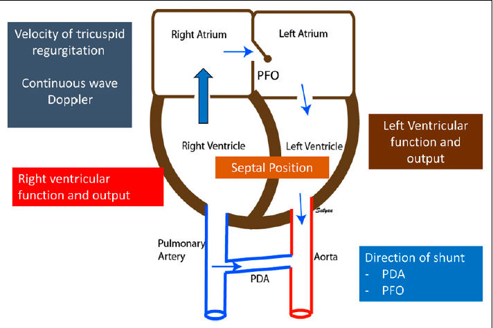 Severe persistent pulmonary hypertension in a neonate with