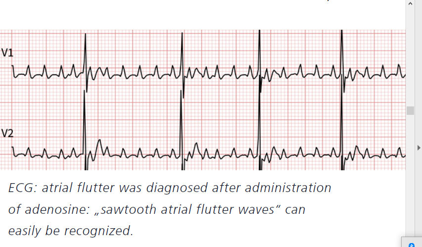 Figura 2 ECG Se Diagnostic Flutter Auricular Post Administraci n De Figura 2 ECG Se Diagnostic Flutter Auricular Post Administraci n De